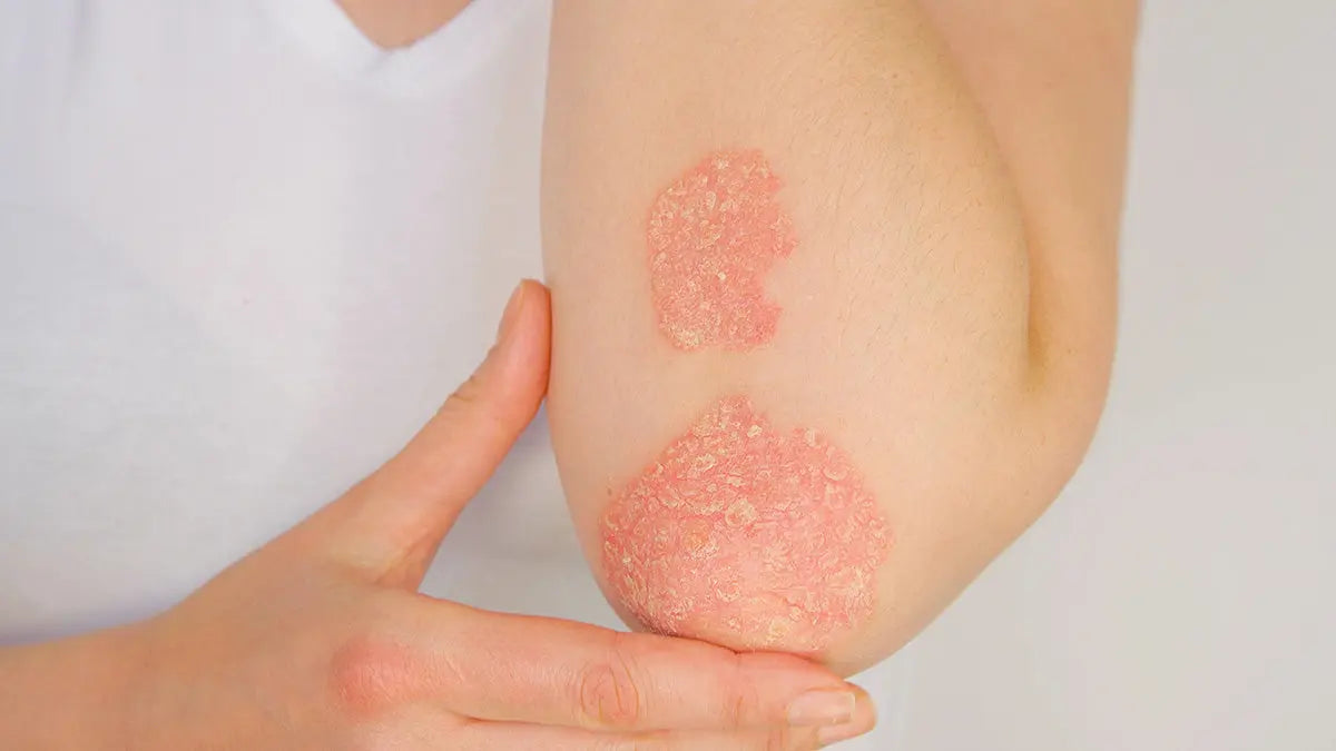 830-nm and 633-nm phototherapy in the treatment of recalcitrant psoriasis